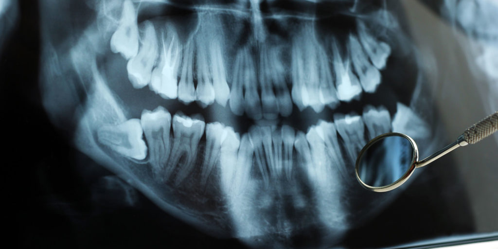 impacted tooth xray